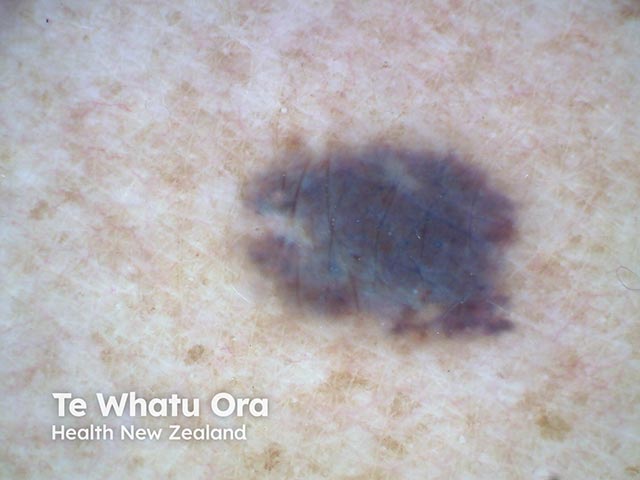 Dermoscopic image of a blue naevus on the upper arm