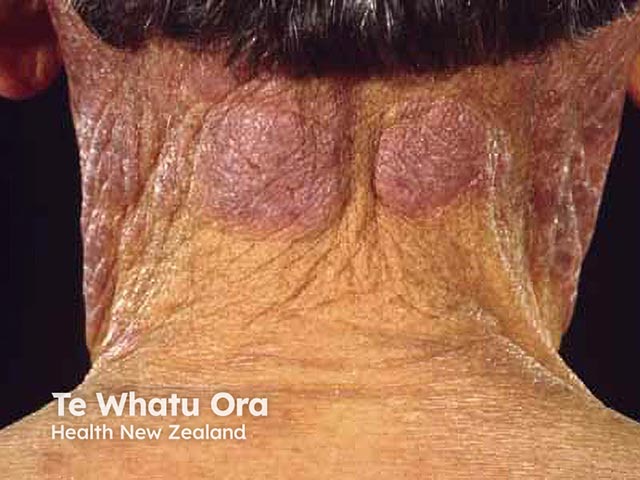 Severe chronic actinic dermatitis with sparing below the neck line and in the skin creases