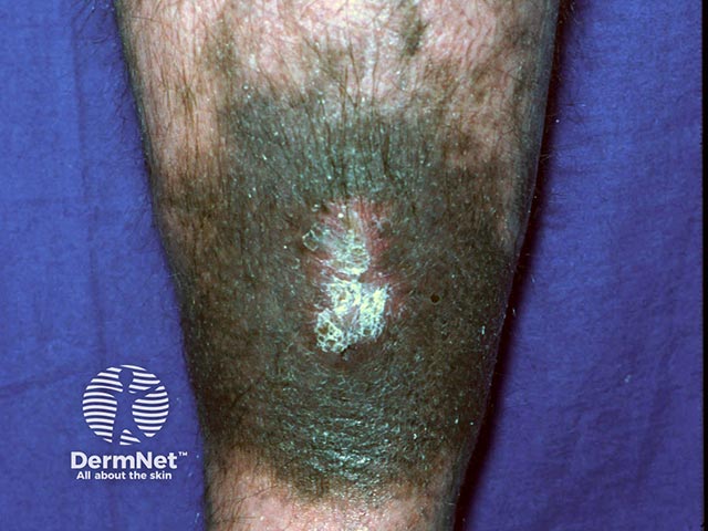 Blue pigmentation due to long-term minocycline use for pyoderma gangrenosum