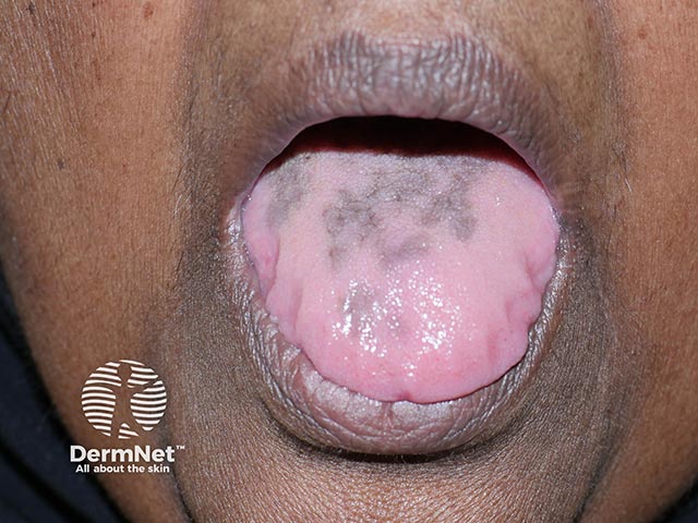 Pigmentation of the tongue from hydroxychloroquine administration