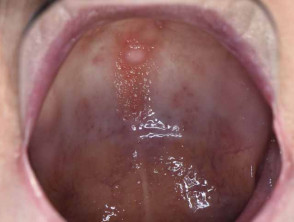 Oral irritated fibroma