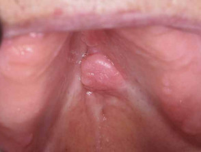 Oral irritated fibroma
