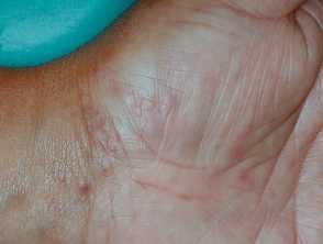 Dyshidrotic eczema (pompholyx)