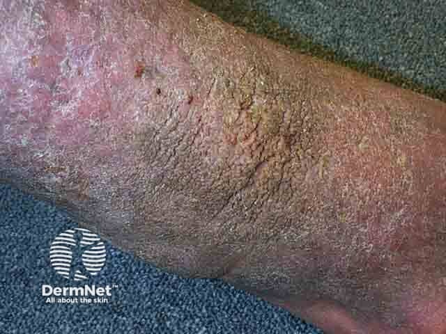 Elephantiasis nostras verrucosa
