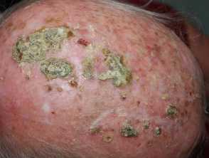 Erosive pustular dermatosis of the scalp