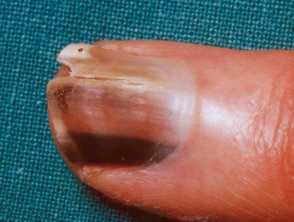 Melanoma of the nail unit
