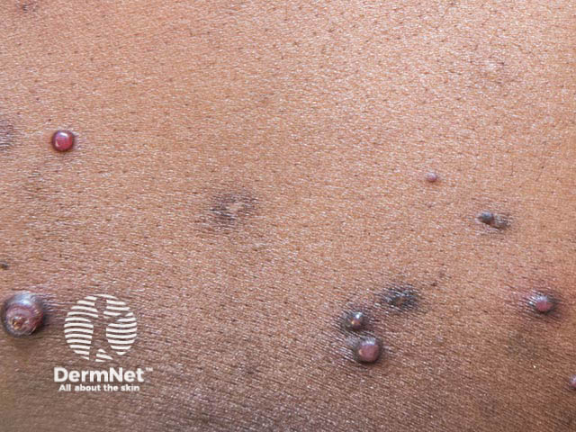 Close-up of mollusca in various stages including some post-mollusca scars