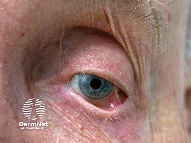 A synaechia of the conjunctiva due to MMP