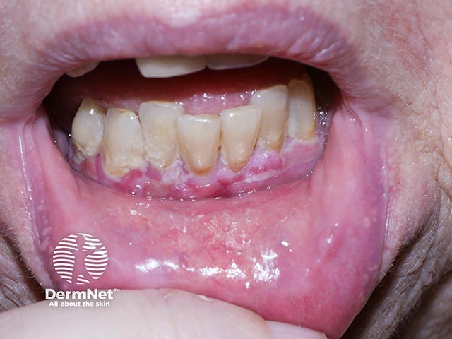 Gingival erosions due to MMP