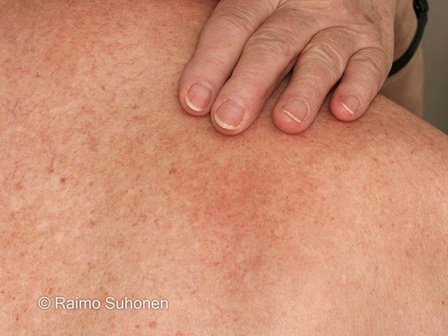 Localised pigmentation due to persistent scratching on the upper back - early lesions are itchy and may show no objective skin changes