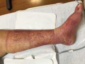 Papular purpuric gloves and socks syndrome