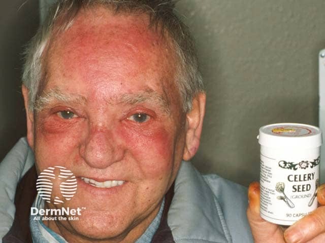 Erythema after sun exposure from eating celery seeds