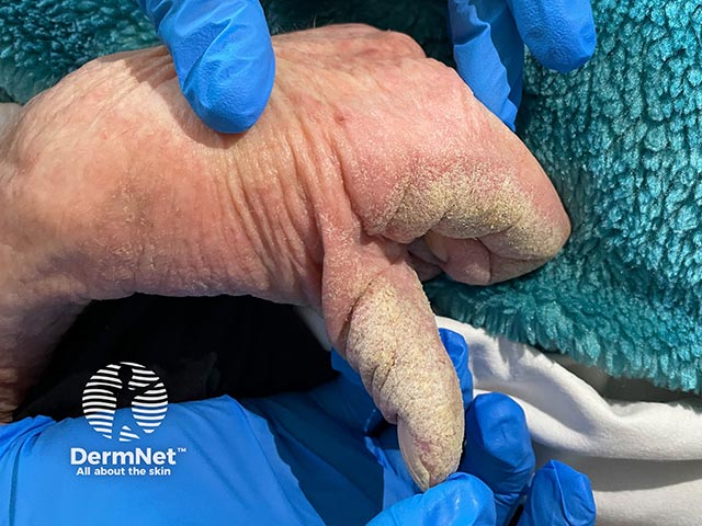 Thick crusted plaques on the thumb and palm due to crusted scabies in an elderly woman