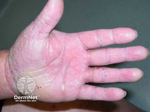 Lichen planus on the palms producing a keratoderma