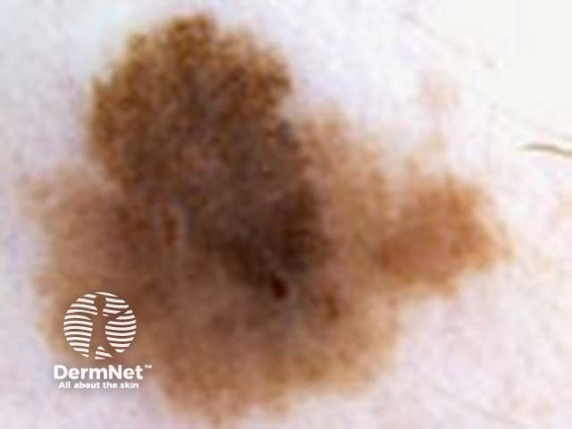 Melanoma