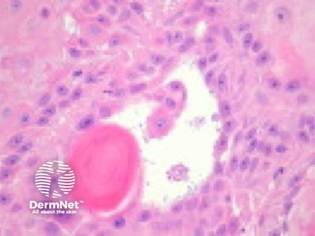 Acantholytic squamous cell carcinoma pathology
