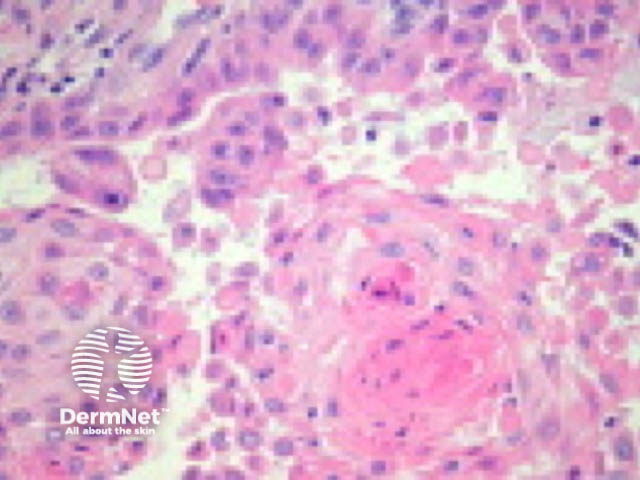 Acantholytic squamous cell carcinoma pathology