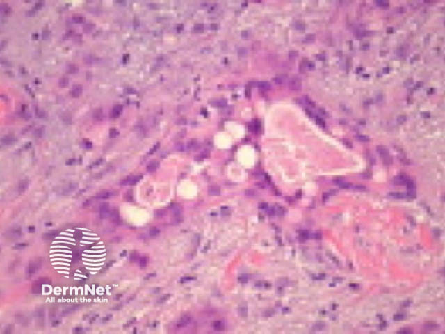 Adenosquamous carcinoma pathology