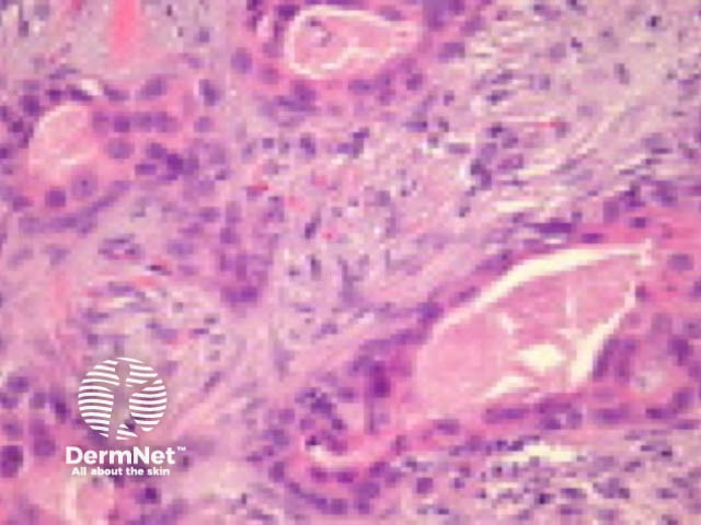 Adenosquamous carcinoma pathology