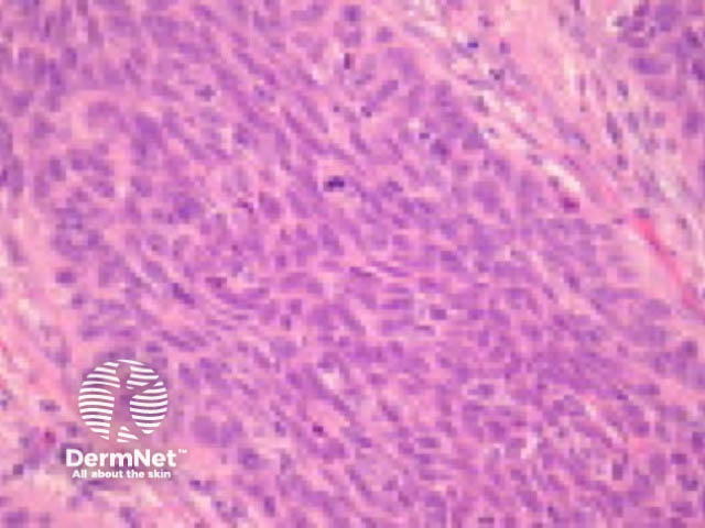 Basaloid squamous cell carcinoma pathology