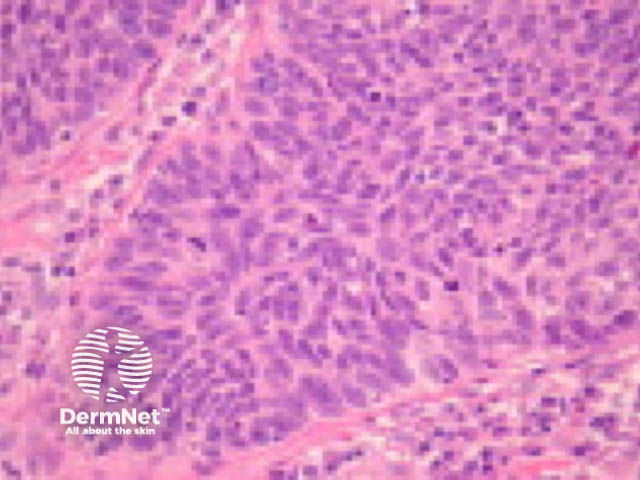 Basaloid squamous cell carcinoma pathology