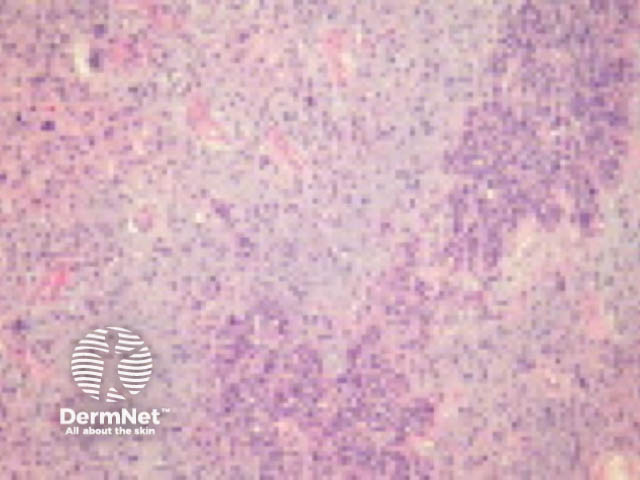 Carcinosarcoma pathology