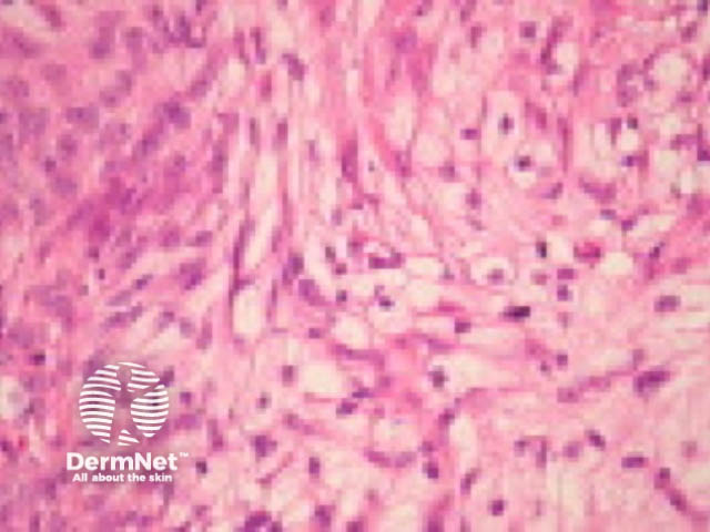 Clear cell squamous cell carcinoma pathology