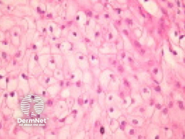 Clear cell squamous cell carcinoma pathology