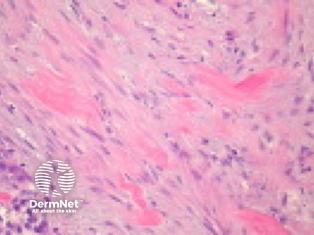 Desmoplastic squamous cell carcinoma pathology