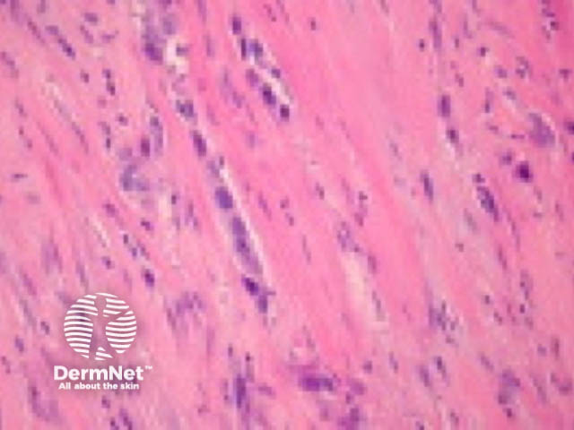 Desmoplastic squamous cell carcinoma pathology