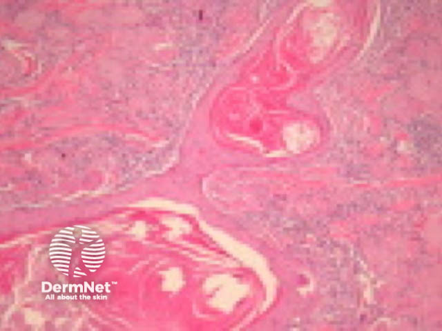 Follicular squamous cell carcinoma pathology