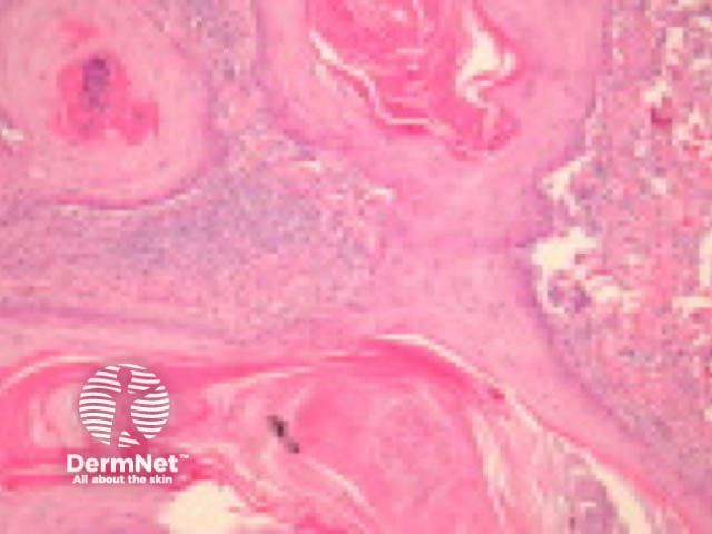 Follicular squamous cell carcinoma pathology