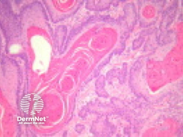 Follicular squamous cell carcinoma pathology