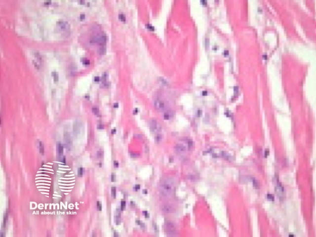 Infiltrative squamous cell carcinoma pathology