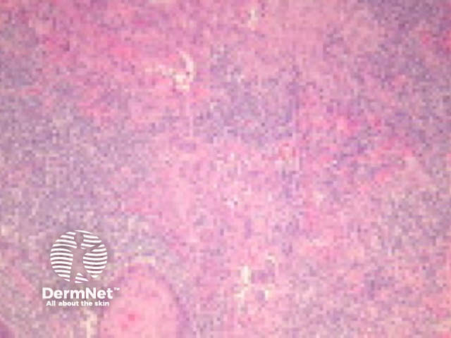 Inflammatory squamous cell carcinoma pathology