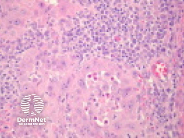 Inflammatory squamous cell carcinoma pathology