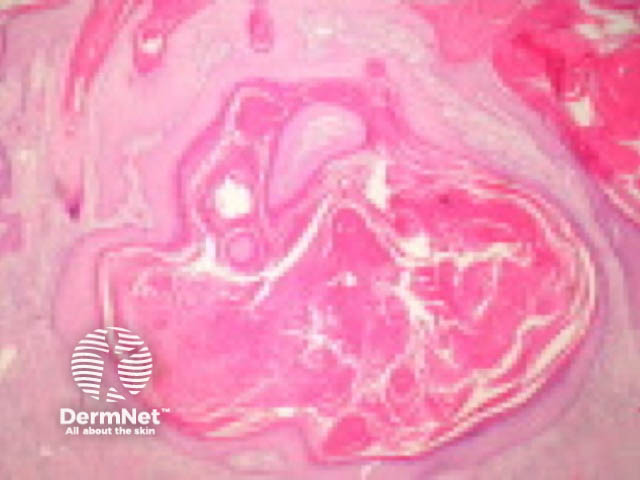 Keratoacanthoma pathology
