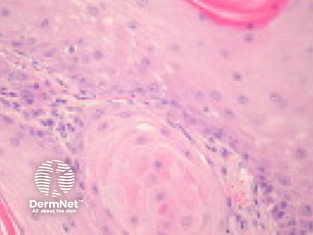 Keratoacanthoma pathology