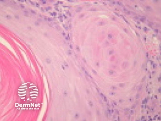 Keratoacanthoma pathology