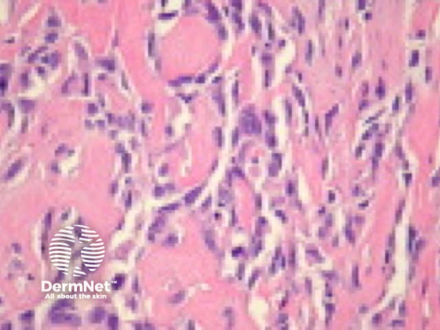 Pseudovascular squamous cell carcinoma pathology