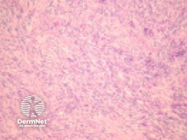 Spindle cell squamous cell carcinoma pathology