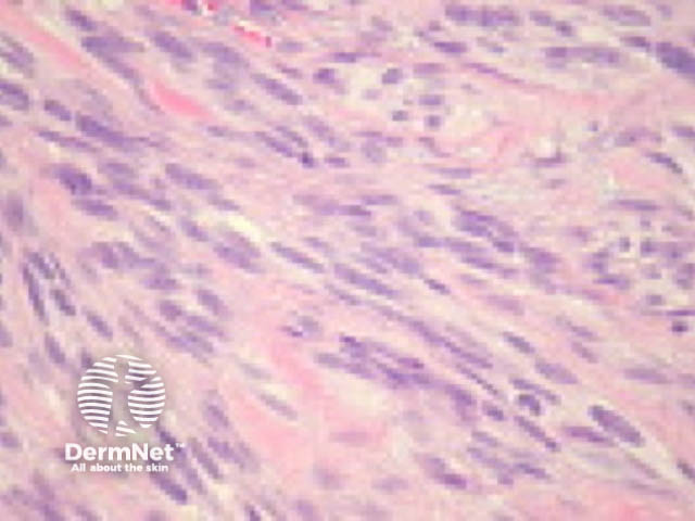 Spindle cell squamous cell carcinoma pathology