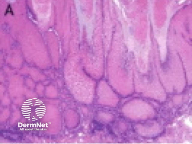 Verrucous carcinoma pathology