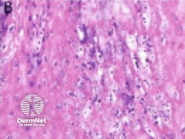 Desmoplastic squamous cell carcinoma pathology