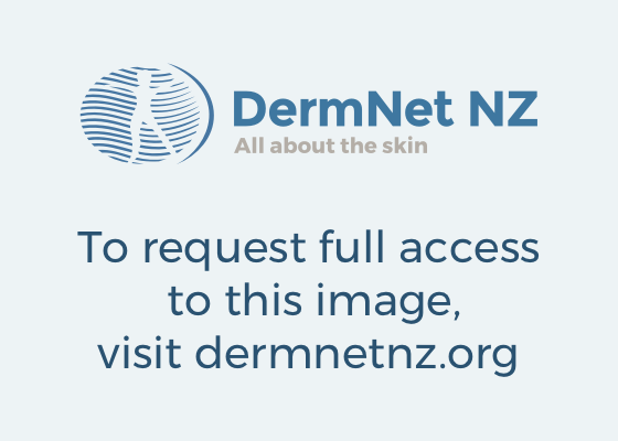 Chronic superficial scaly dermatitis. DermNet NZ