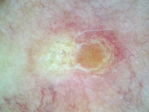 Intraepidermal carcinoma, polarised dermoscopy view