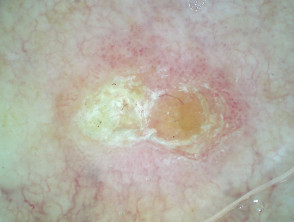 Intraepidermal carcinoma, nonpolarised dermoscopy view
