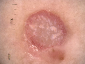 Amelanotic melanoma: dermoscopy