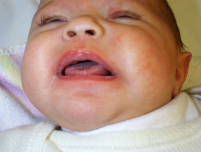 Infantile oral thrush