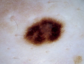 Naevus, skin type 4, dermoscopy 3